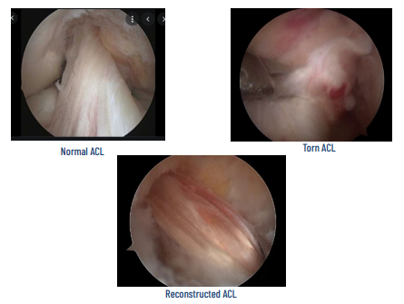 acl normal